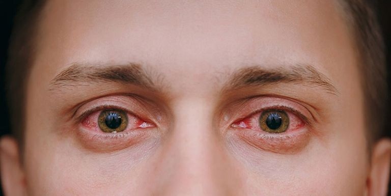 Phương pháp phòng tránh bệnh đau mắt đỏ